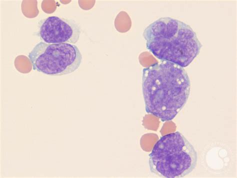 Mantle cell lymphoma CSF