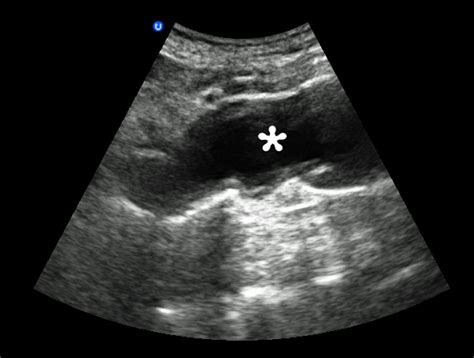 Abdominal Aortic Aneurysm – Core EM