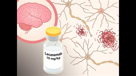 Lecanemab in Alzheimer’s Disease | NEJM - YouTube