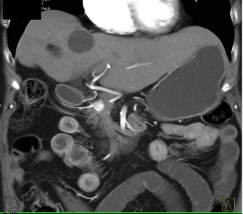 Pancreatic Cancer Presents with Gastric Outlet Obstruction Symptoms due to Invasion of Duodenum ...