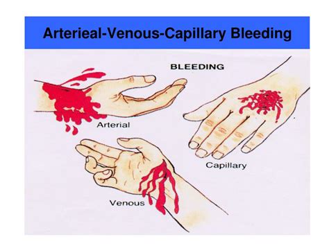 Arterial Bleeding