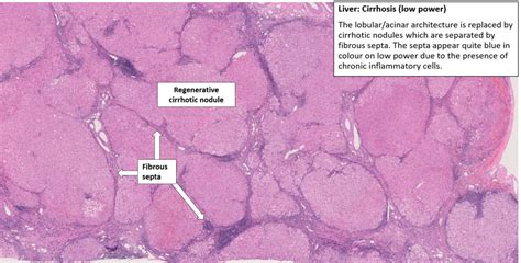 Liver – Cirrhosis with Hepatocellular Carcinoma – NUS Pathweb :: NUS Pathweb