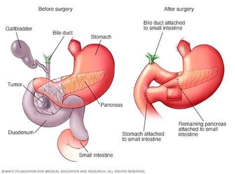 Procedimiento de Whipple - Mayo Clinic