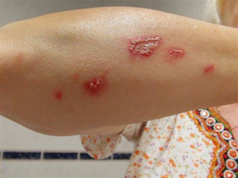 Flickriver: Most interesting photos tagged with dermatitis