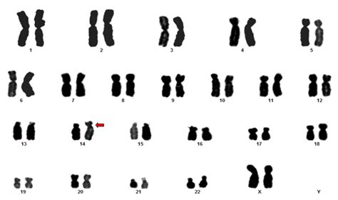 Translocation Down Syndrome Karyotype