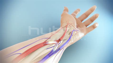 Arteriovenous (AV) Fistula | Hybrid Medical Animation