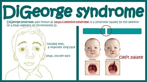 Digeorge Syndrome Facial Features – Telegraph