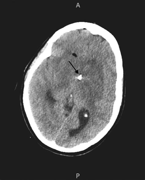 Computed tomography head after external ventricular drain placement ...