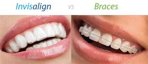 Invisalign: The Hidden Facts. Is Invisalign Effective?