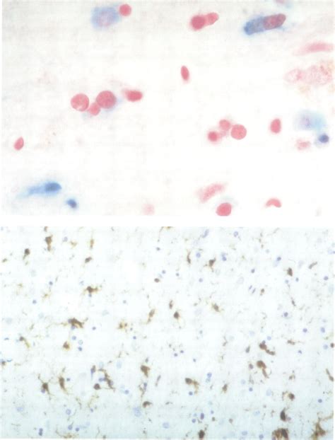 Light microscopic investigations of the lateral putamen in patient 1 ...