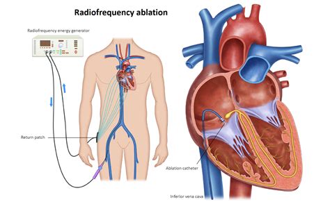 Catheter Ablation - Melbourne Heart Group