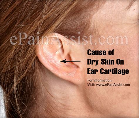 Ear dryness t