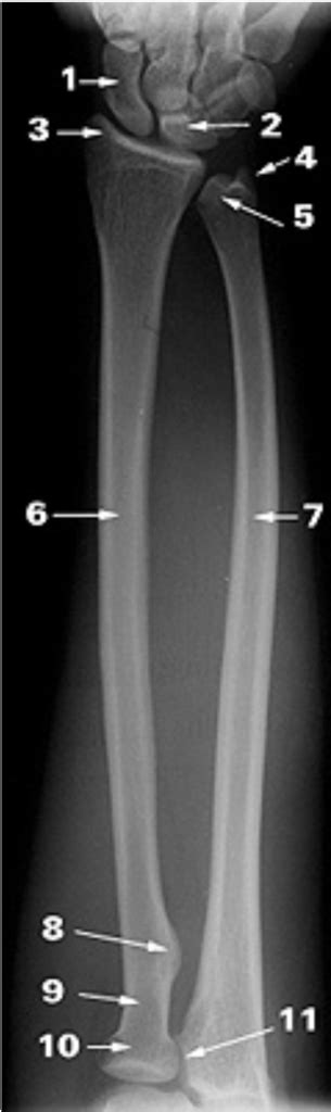 Xray forearm Diagram | Quizlet