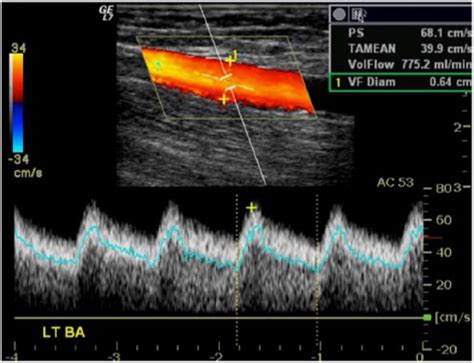 Dialysis Fistula Ultrasound