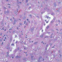 Epithelioid Mesothelioma: Epithelial Cell Prognosis & Treatment