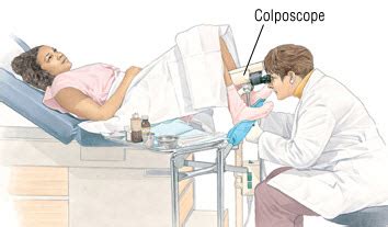 Colposcopy - Pictures