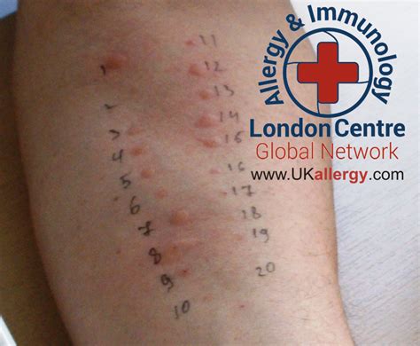 Skin Allergy Testing London, Skin Prick Testing London