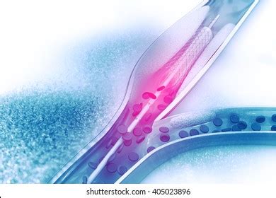 Stent Angioplasty Procedure Placing Balloon Stock Illustration 405023896 | Shutterstock