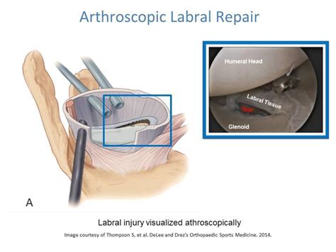 Shoulder Labral Tear- Labral Repair and Rehabilitation: Ashvin K. Dewan ...