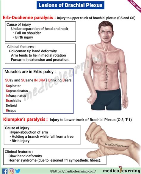 Brachial Plexus Lesions – MedicoLearning