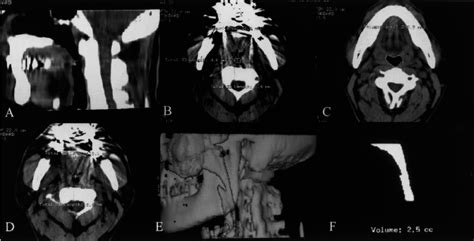 A standard 3-D CT scan of the upper airway. (A) Sagittal view of the ...