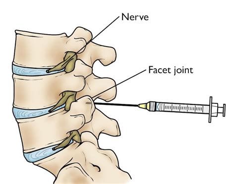 facet-joint-injections | AllSpine