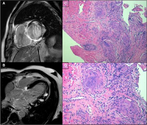 Cardiac magnetic resonance and histology of cardiac sarcoidosis. In ...