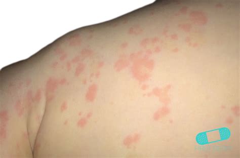 Online Dermatology - Erythema multiforme