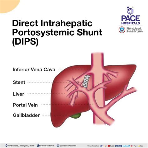 Budd-Chiari syndrome (Hepatic Vein Thrombosis) - DIPS procedure