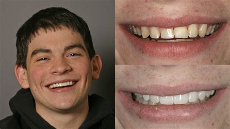 Before & After Composite Veneers