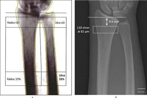 Cortical bone thickness of the distal radius predicts the local bone mineral density | Bone & Joint