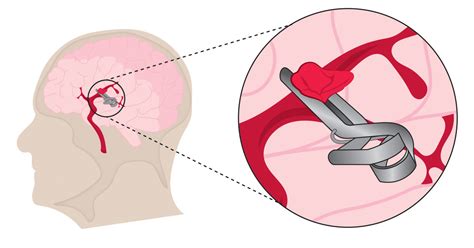 Aneurysm Clipping - Lake Charles, LA - Spine and Brain Surgery - Dr. Matthew Burton MD