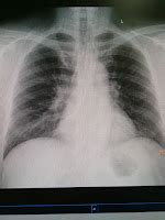 Chest X Ray Bronchitis - Radiology Imaging