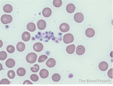 Platelet Clumping • The Blood Project