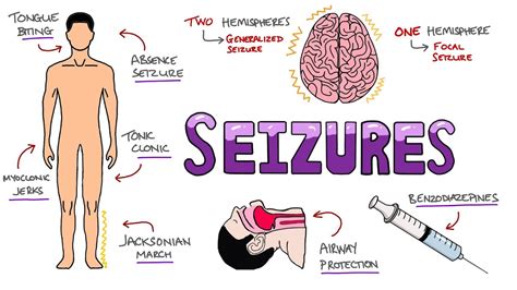 Seizures Seizure Types Generalized Vs Focal Seizures Causes Of Seizures Mnemonic – Otosection