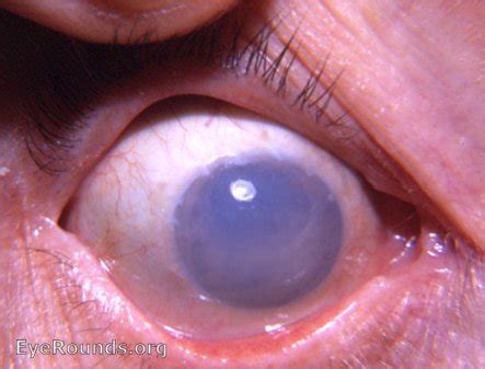 bullous keratopathy following intracapsular cataract surgery. EyeRounds.org: Online Ophthalmic Atlas