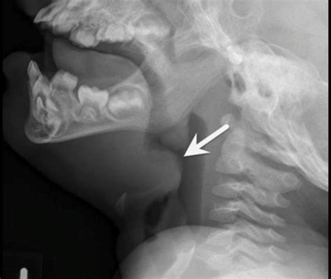 Epiglottitis – Child – Undergraduate Diagnostic Imaging Fundamentals