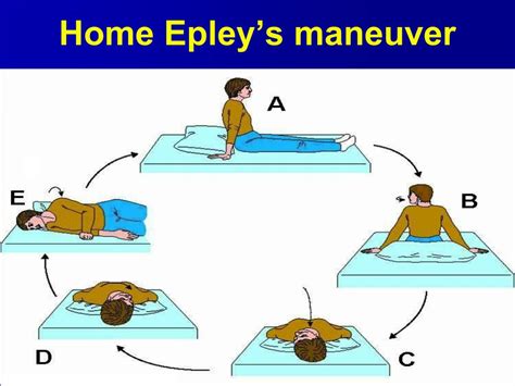 Diagram Of Epley Maneuver