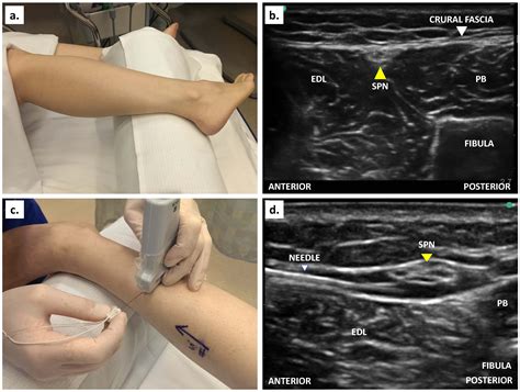 Ultrasound guided ankle block