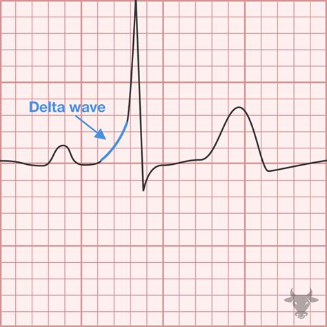 Wpw Syndrome Delta Wave