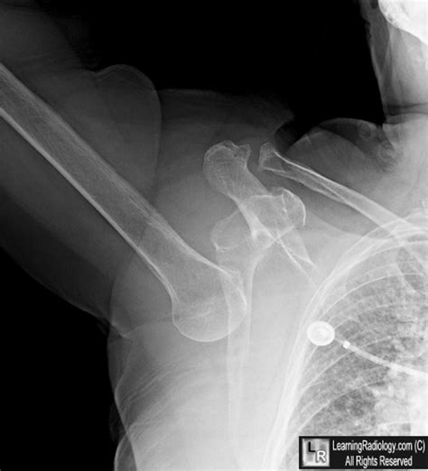 LearningRadiology - Luxatio erecta, inferior, shoulder, dislocation