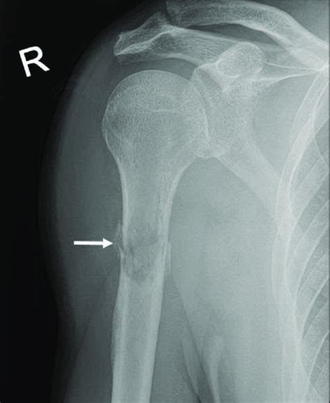 Proximal Humeral Fracture Radiology Reference Article Radiopaedia Org ...