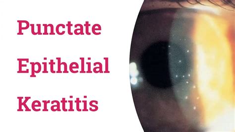 Punctate Epithelial Keratitis (PEK) - YouTube