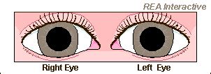 Richmond Eye Associates, Relative Afferent Pupillary Defect