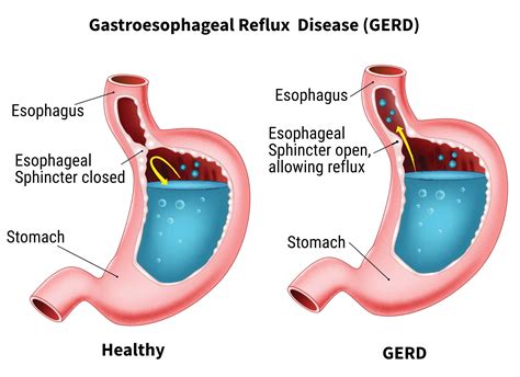 Gerd System Disorder Template - 2023 Template Printable