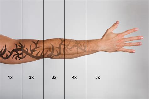 How Long Does Laser Tattoo Removal Take? | Bala Aesthetics