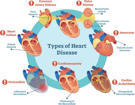Heart Disease: Diagnosis and Treatment - Pulse Cardiology