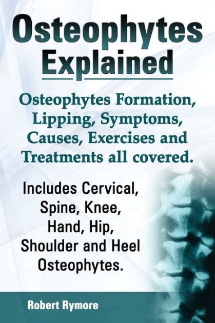 Osteophytes Explained. Osteophytes Formation, Lipping, Symptoms, Causes, Exercises and ...