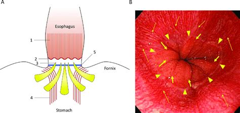 Landmarks of gastro-oesophageal junction (GOJ). (A) Schema of the ...