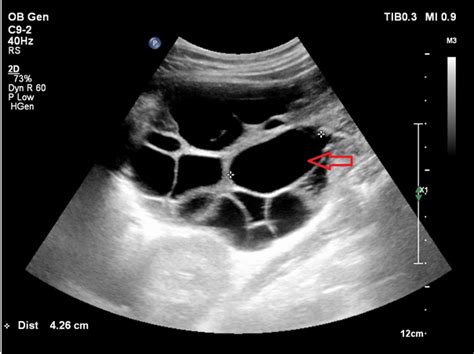 Molar pregnancy – case presentation of 23-year old pregnant women with ...